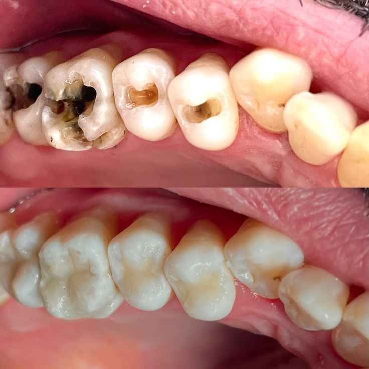 Teeth Filling