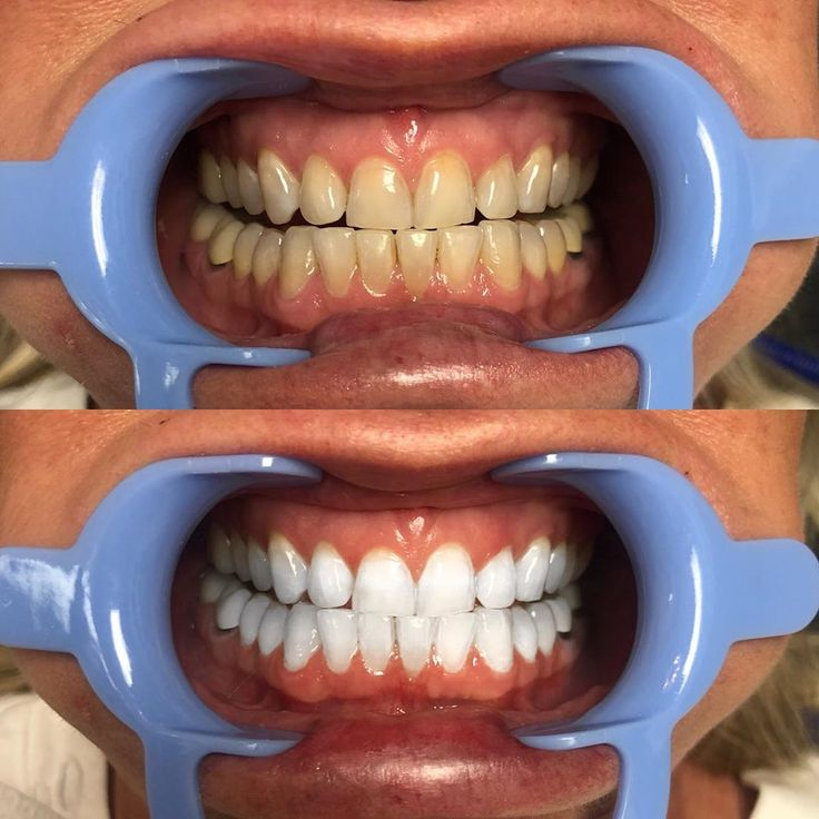 Teeth Whitening