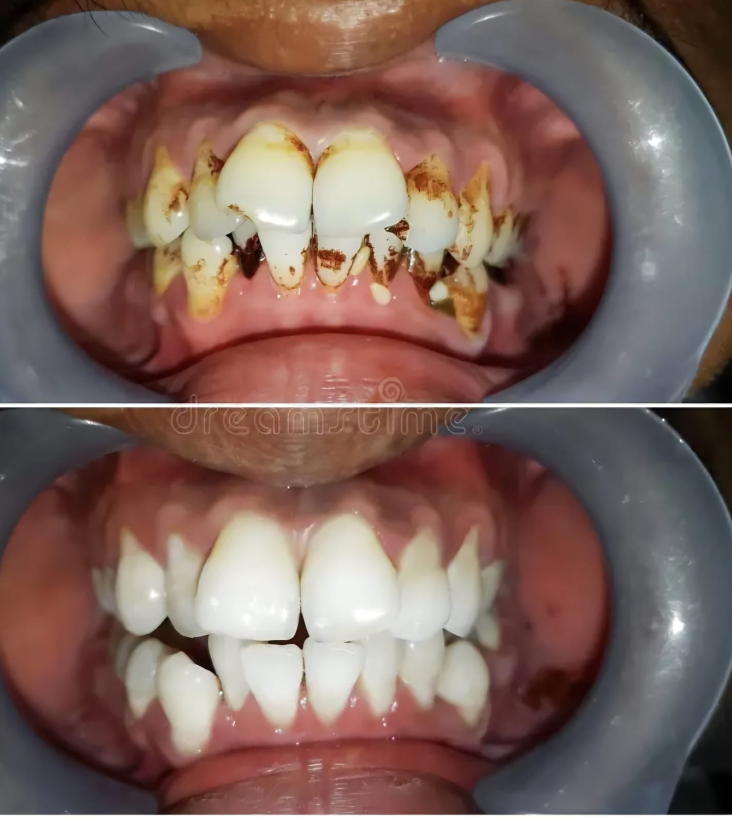 Teeth Cleaning