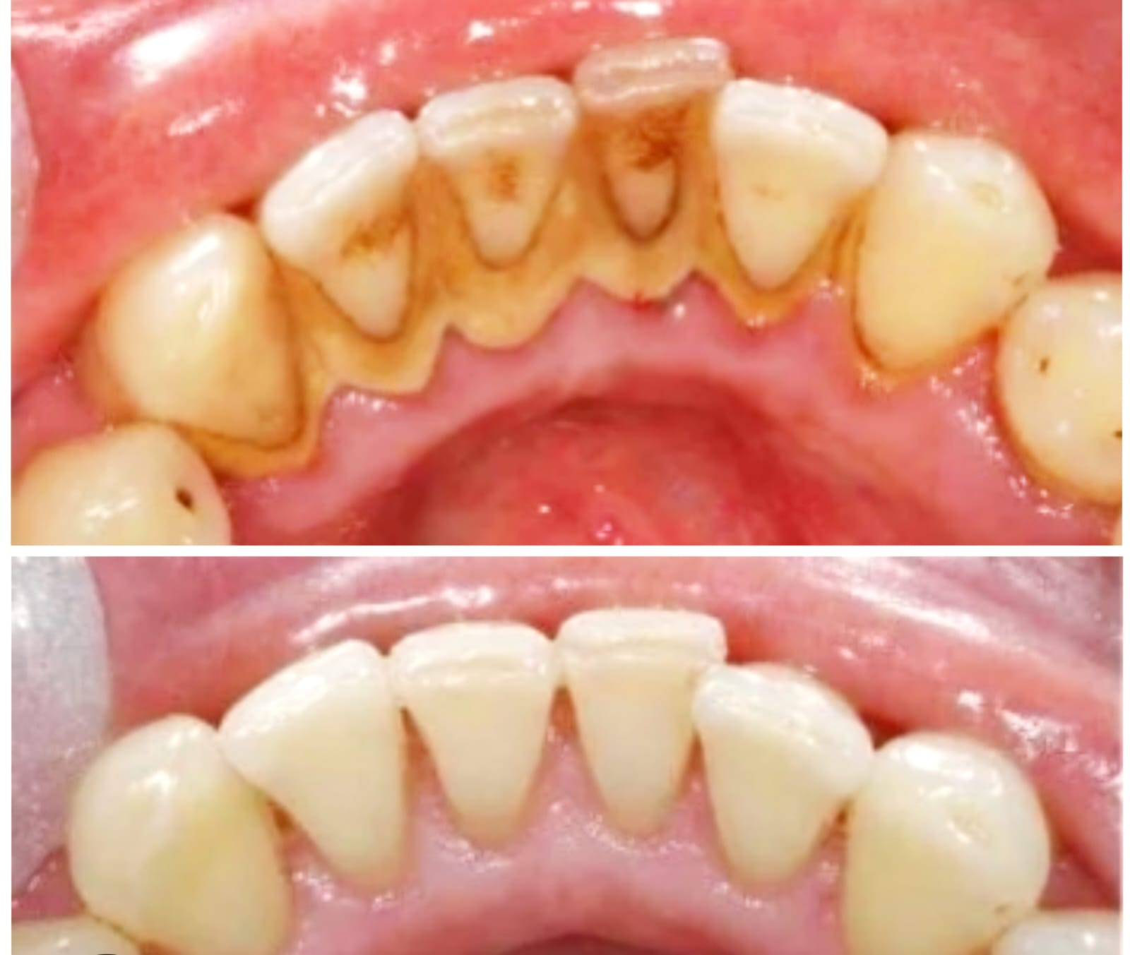 Lower arch scaling — stain & calculus removed