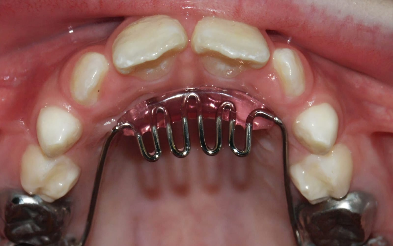 Oral Habits Management
