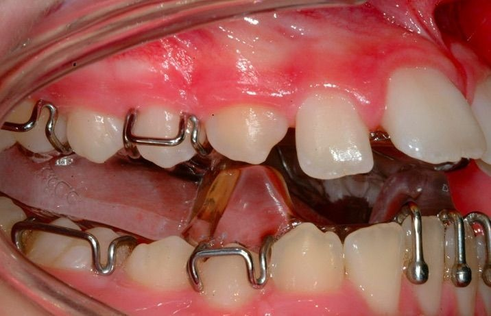 Wire-and-acrylic removable appliance in place