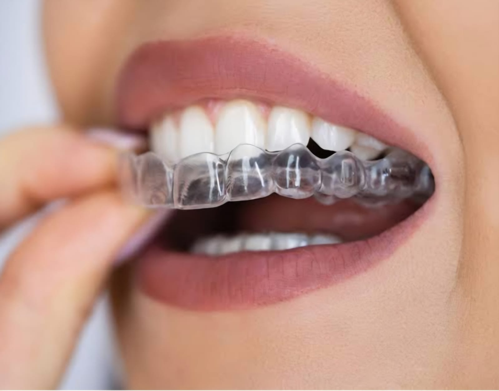 Custom clear transparent retainer — virtually invisible when worn.