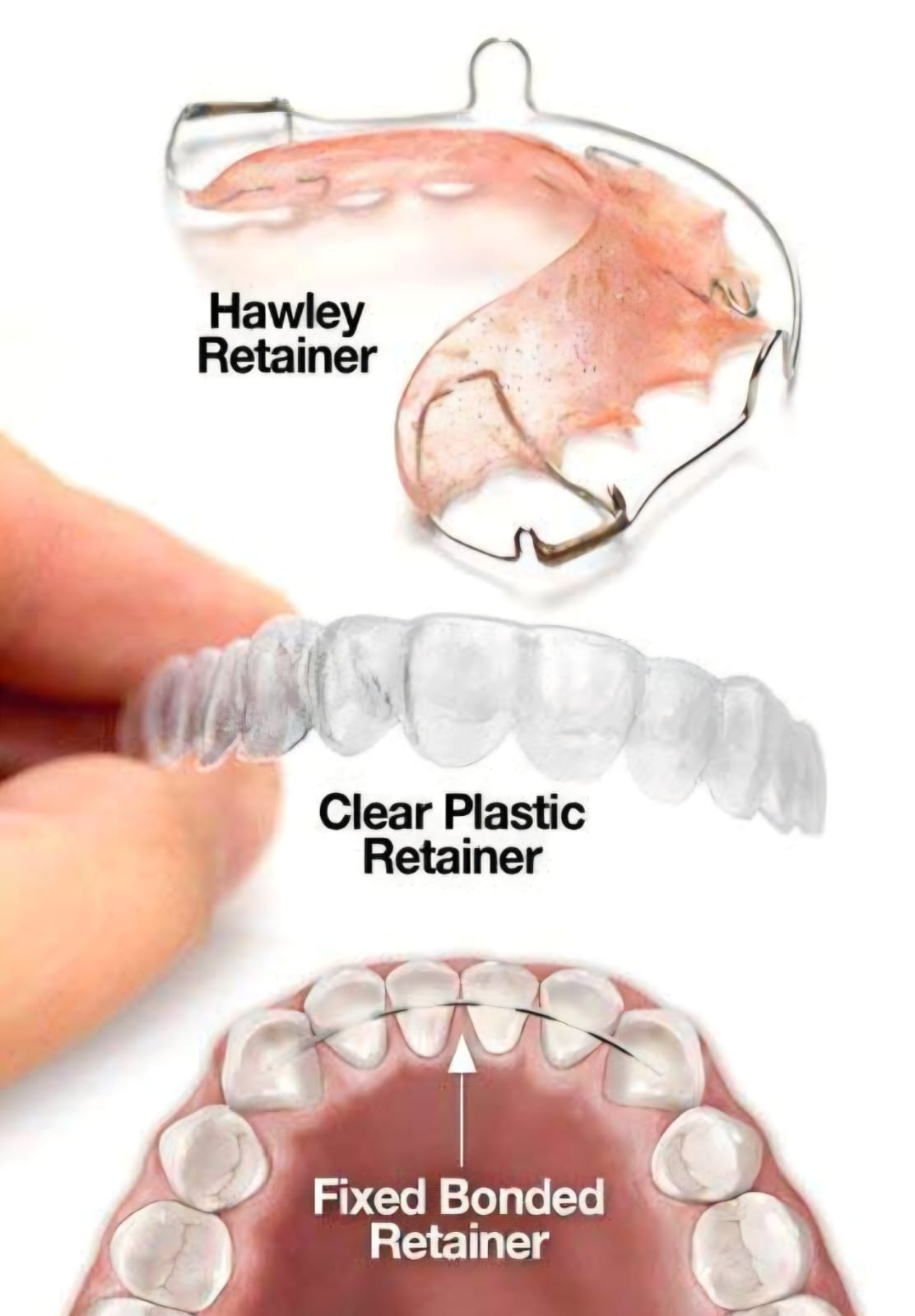 Types of retainers we offer — Hawley, clear plastic and fixed bonded.