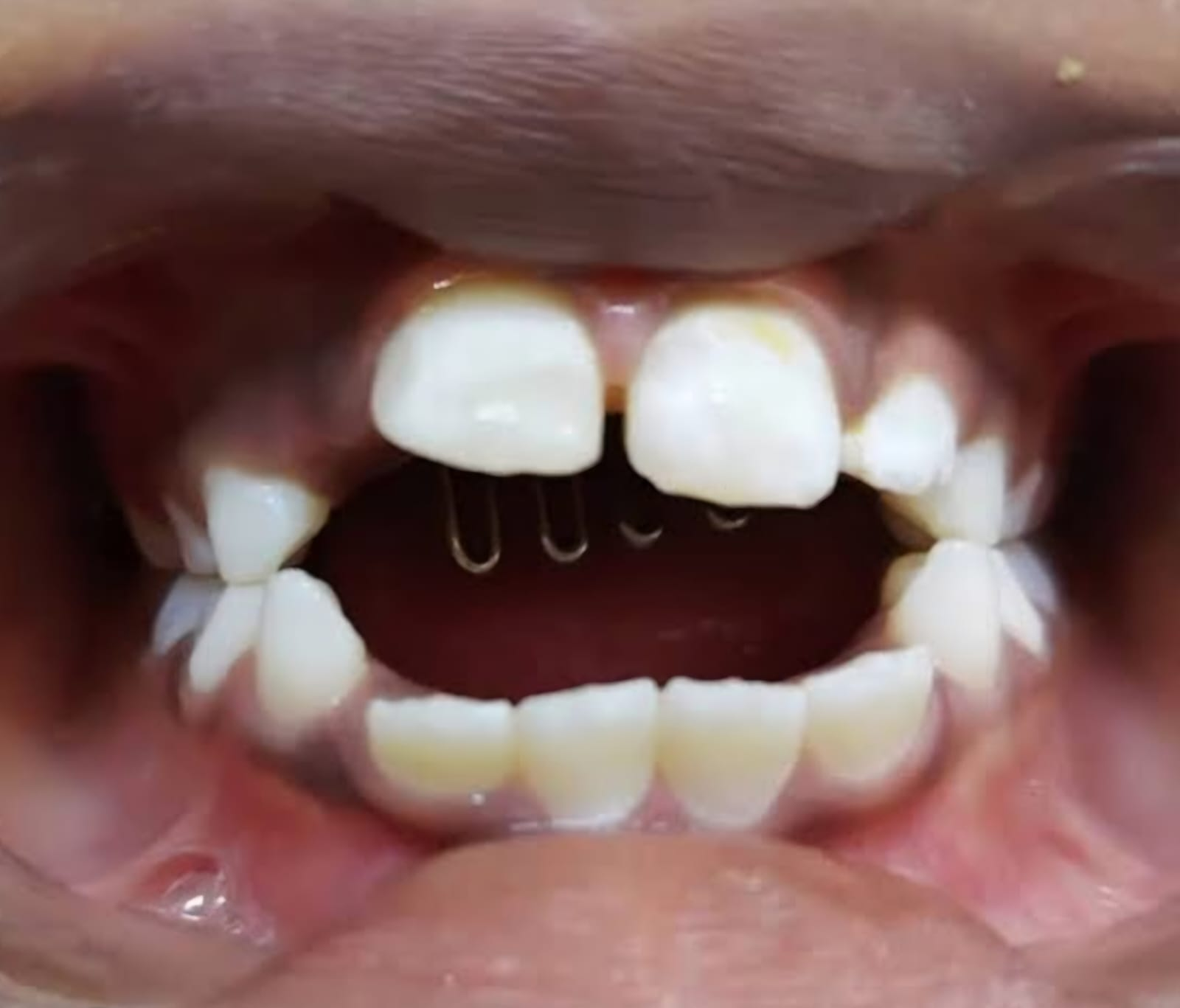 Effects of prolonged thumb sucking — open bite and protruded front teeth corrected with habit breakers.